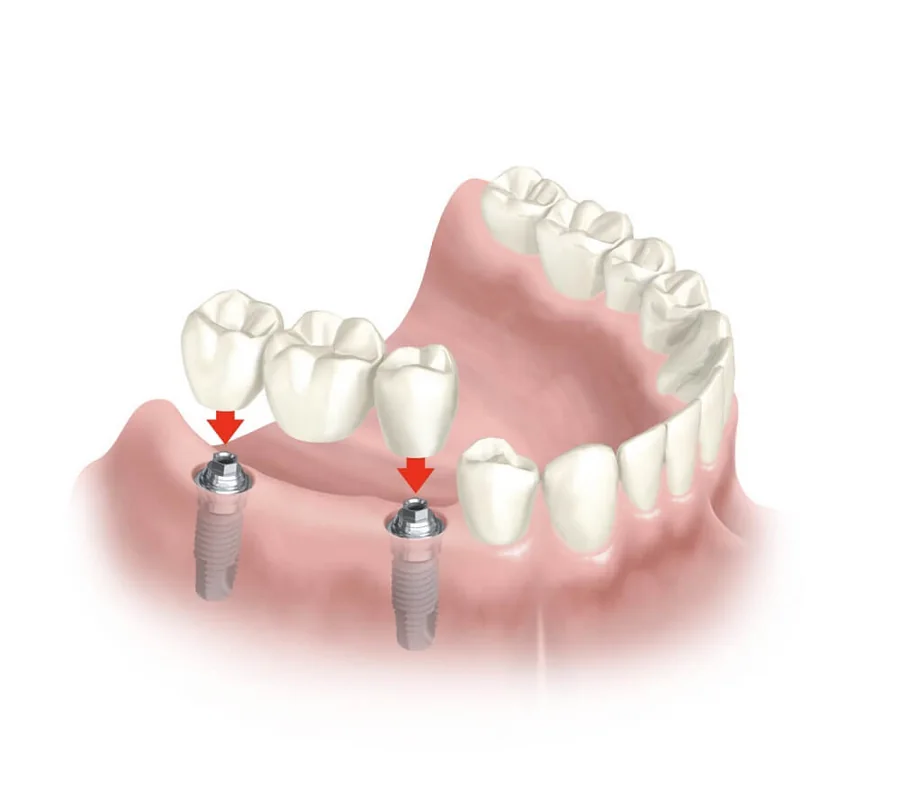 Implante dentário em Santos